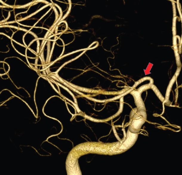 Angiography three-dimensional showing an accessory middle cerebral